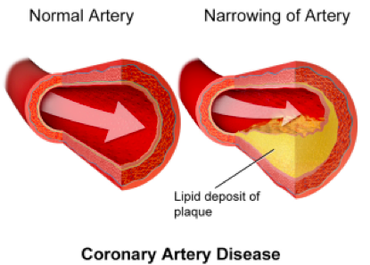 Coronary Artery Disease