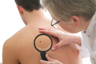Irregular moles are a sign of cancer